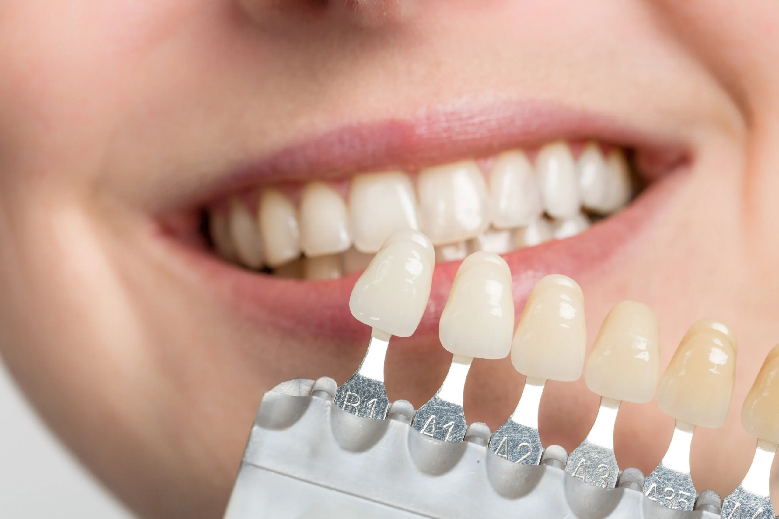 porcelain veneers parkway clinic swansea Preview Image